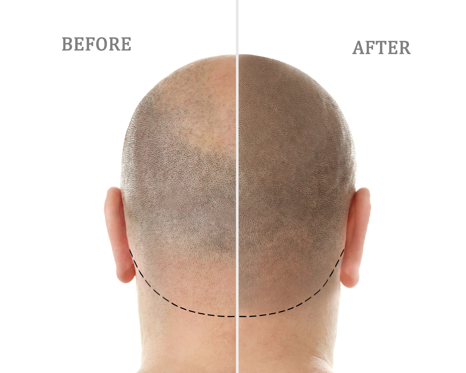 Before and after SMP hairline